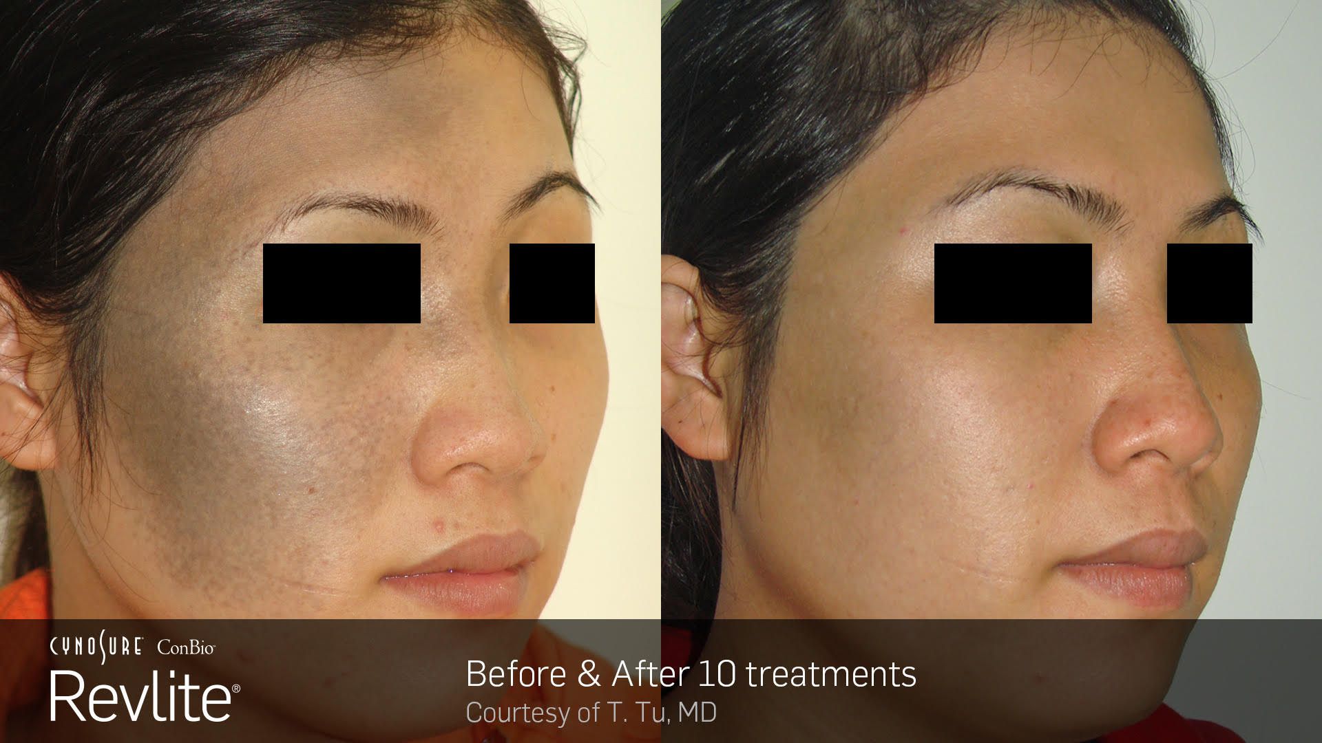 Manufacturer's photo: pigmentation on a woman's cheek, before and after 10 Revlite treatments (courtesy of T. Tu, MD)