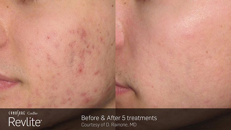 Manufacturer's photo: acne marks on a cheek, before and after 5 Revlite treatments (courtesy of D. Rainone, MD)