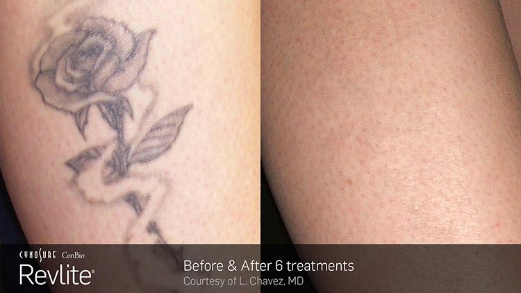 Manufacturer's photo: a rose tattoo on an arm, before and after 6 Revlite treatments (courtesy of L. Chavez, MD)