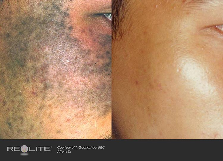 Manufacturer's photo: dark pigmentation on a cheek, before and after 4 Revlite treatments (courtesy of T. Guangzhou, PRC)