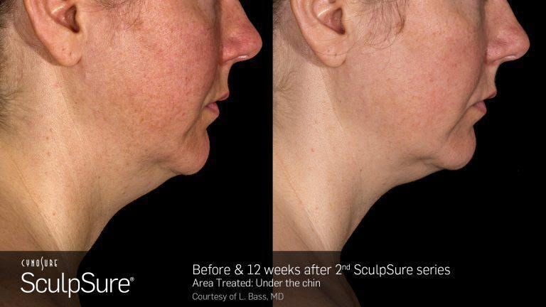 Manufacturer's photo: under the chin, before and 12 weeks after a second SculpSure series (courtesy of L. Bass, MD)