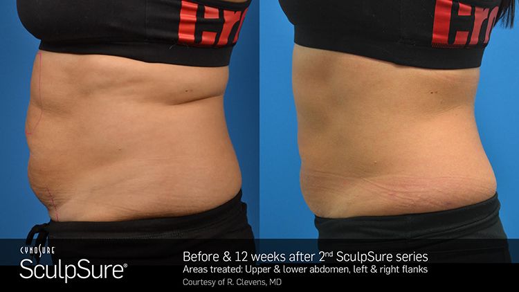 Manufacturer's photo: the upper and lower abdomen and flanks, before and 12 weeks after a second SculpSure series (courtesy of R. Clevens, MD)
